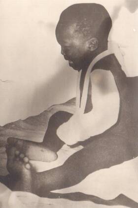 Verletztes Kind aus Biafra.